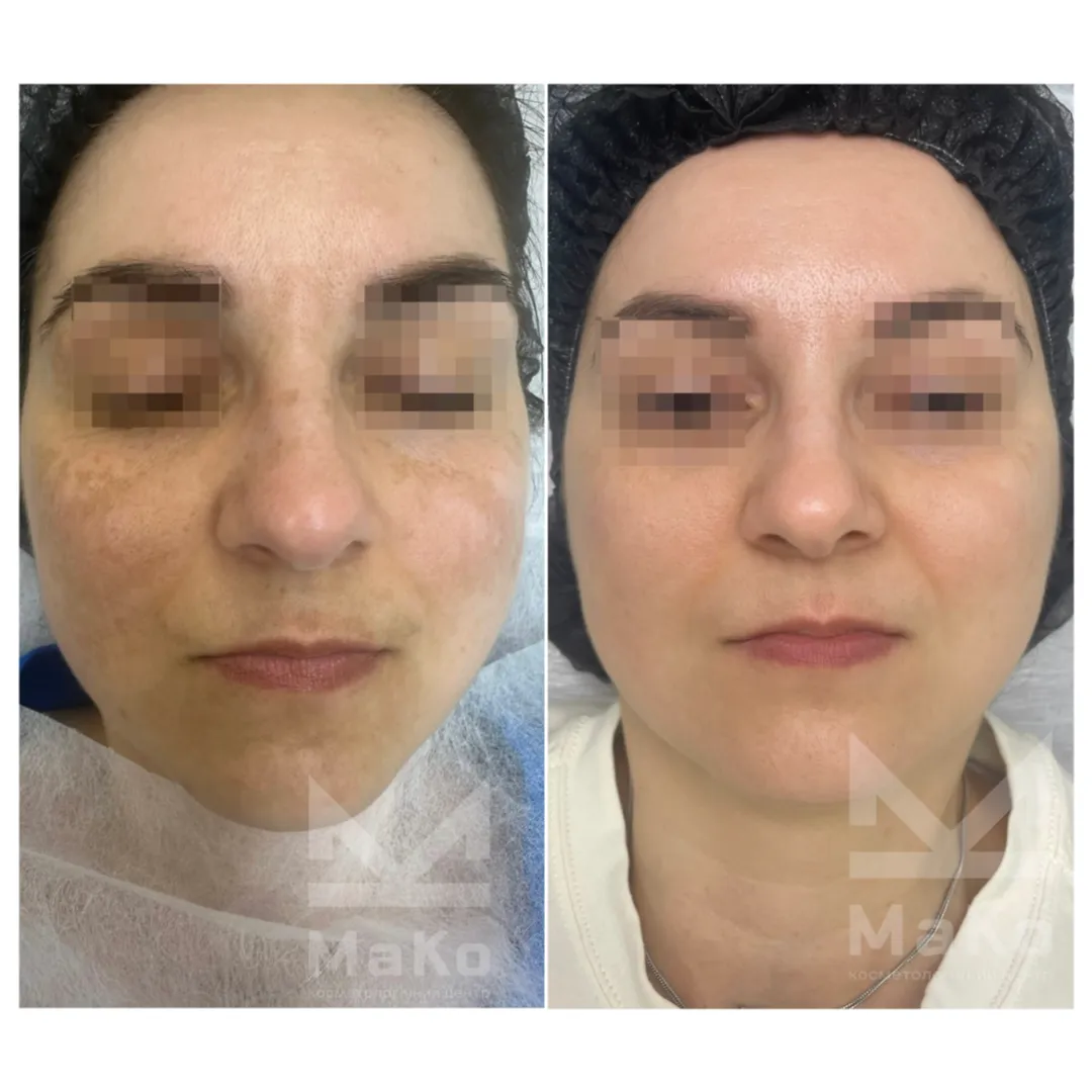 До процедури