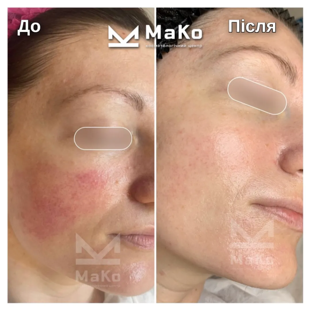 До процедури