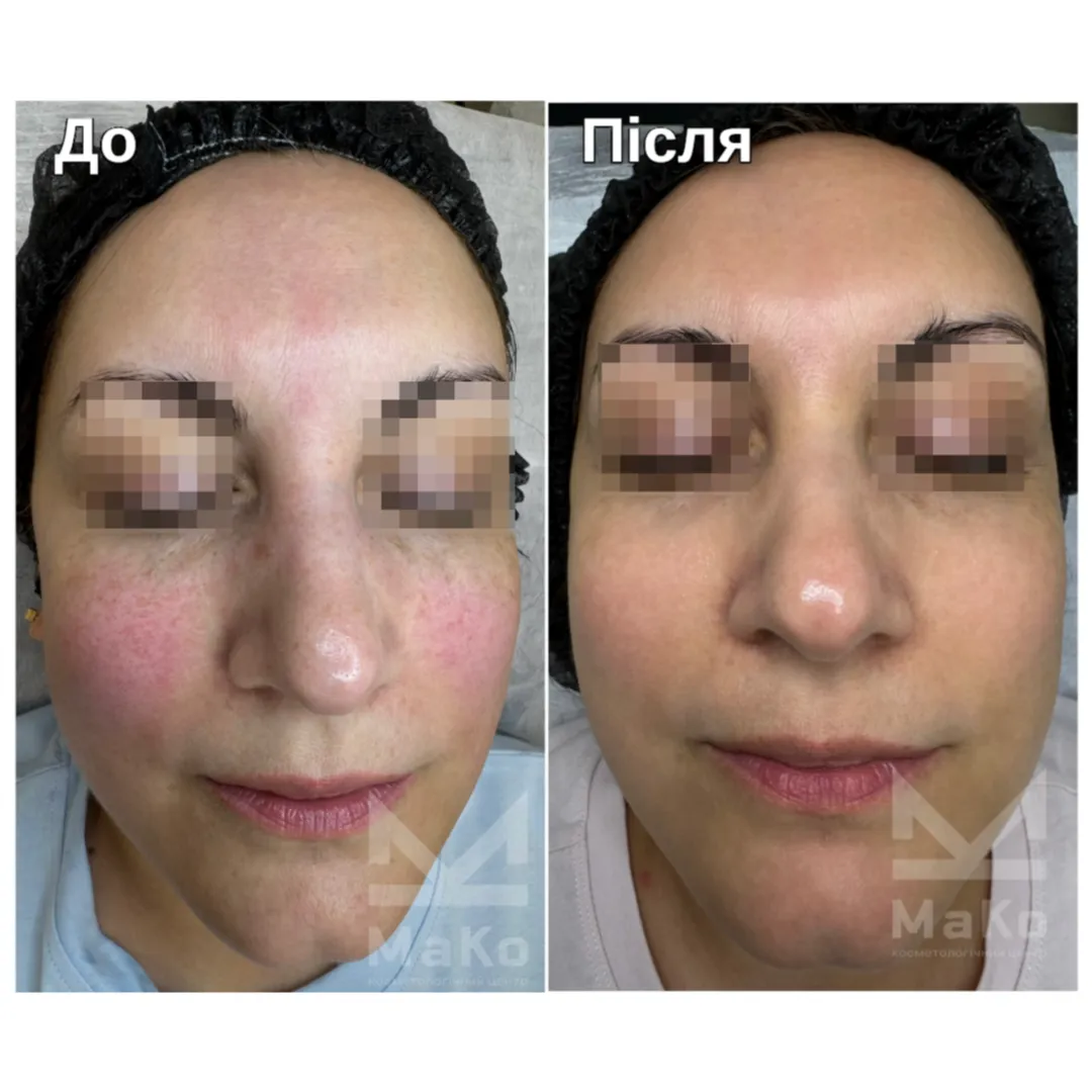 До процедури