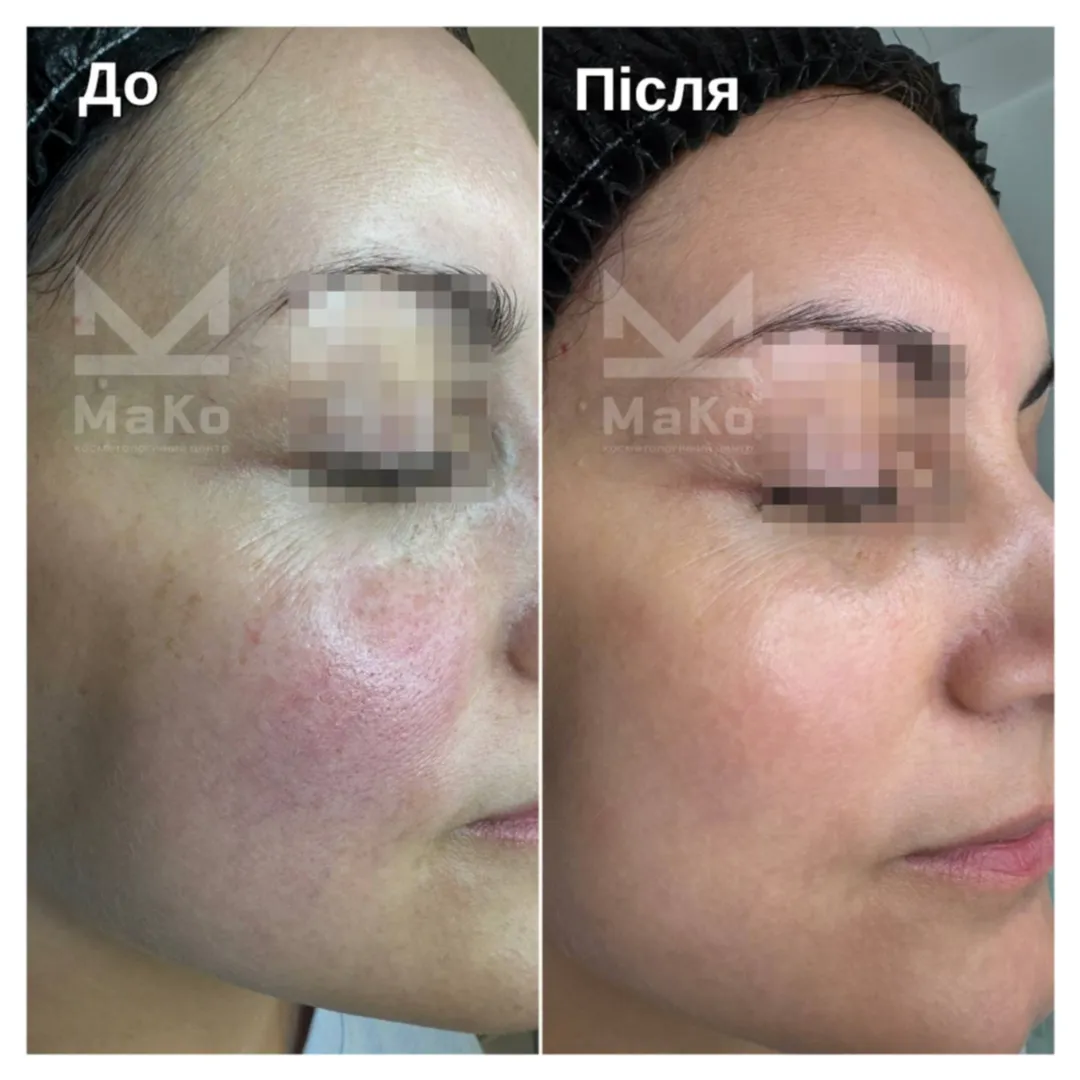 Після процедури