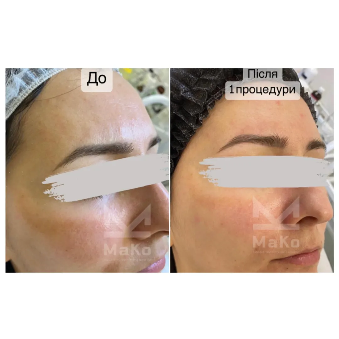 До процедури