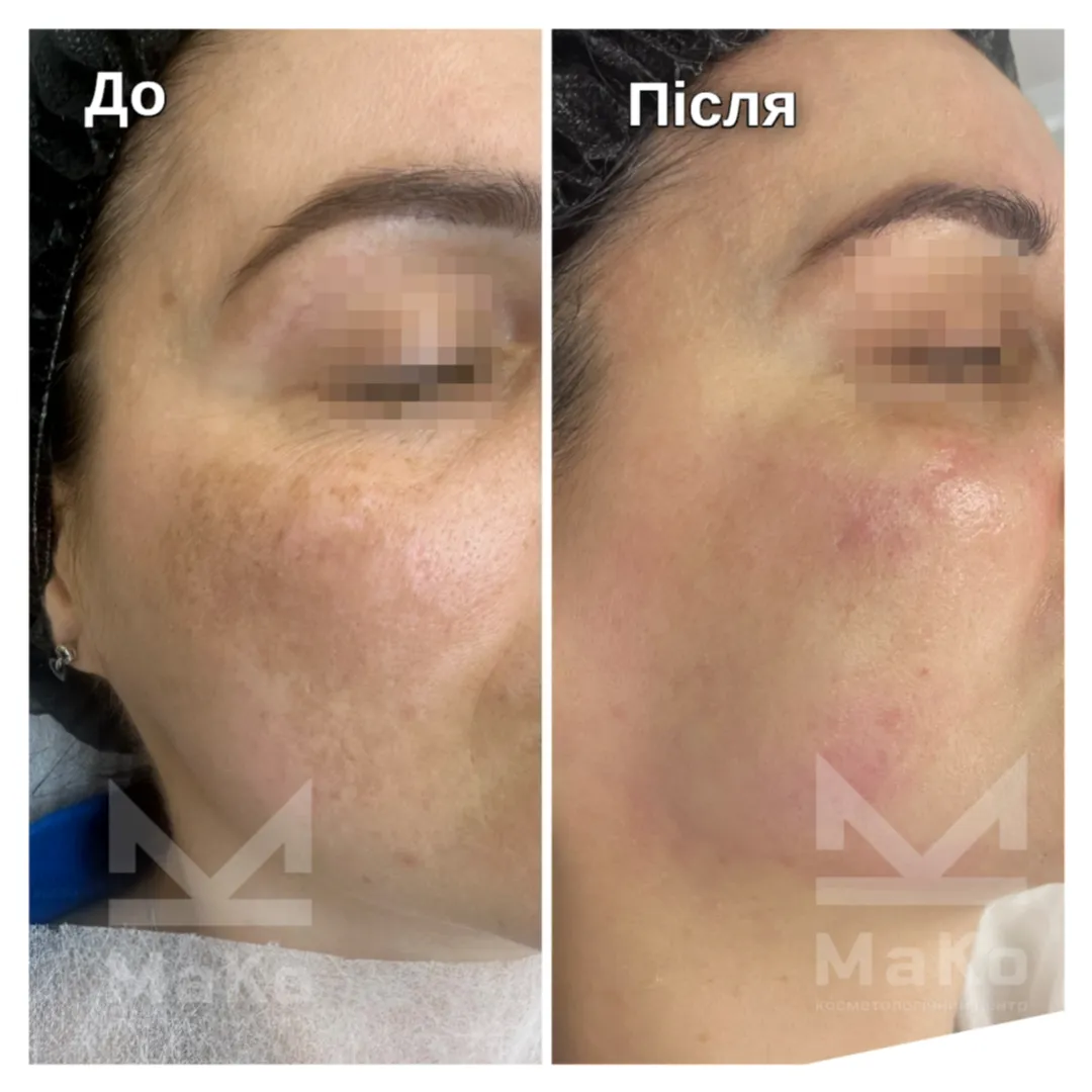 Після процедури