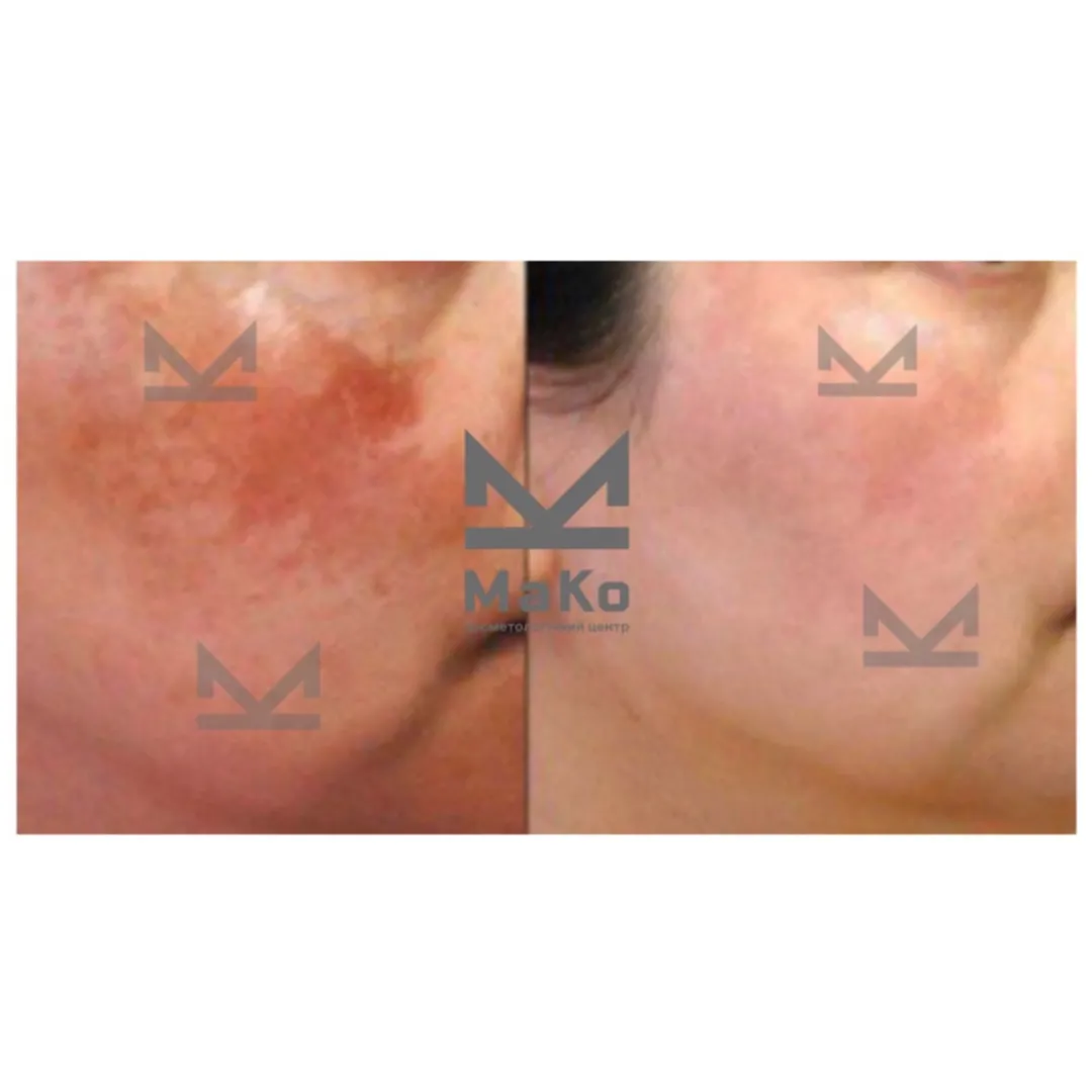 Після процедури