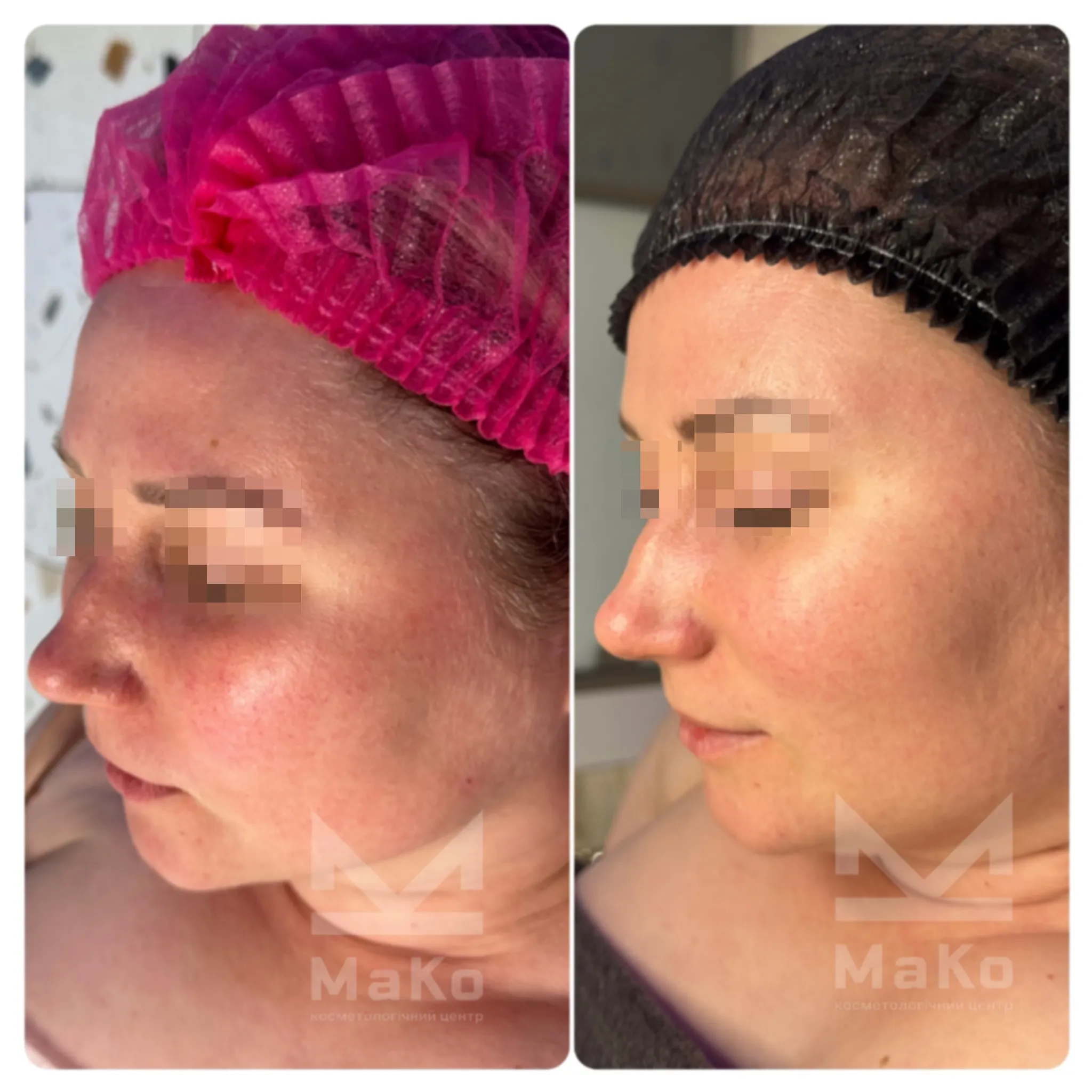 Після процедури