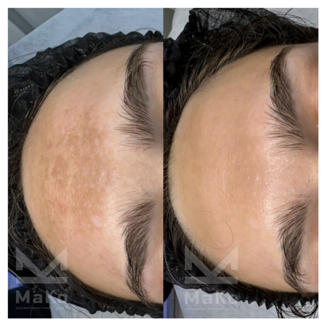 До процедури