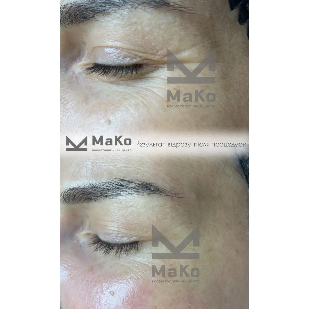 Резурфейсери та пілінги з пептидами