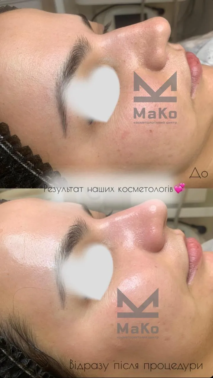 Резурфейсери та пілінги з пептидами