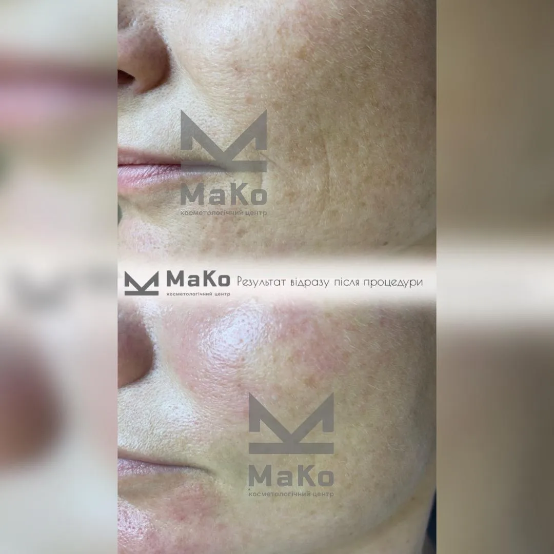 Резурфейсери та пілінги з пептидами