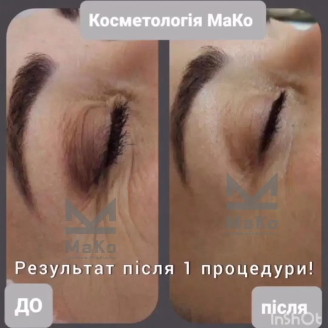 Резурфейсери та пілінги з пептидами