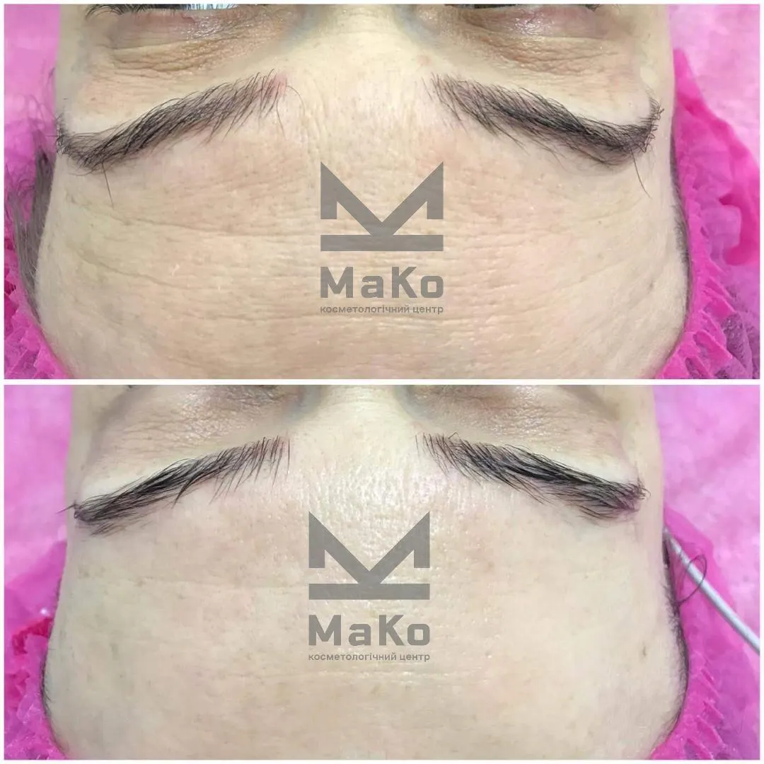 Резурфейсери та пілінги з пептидами