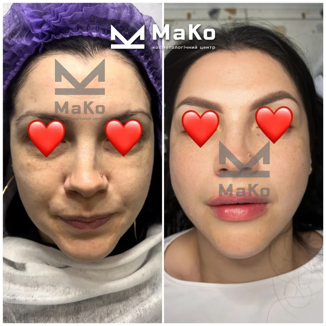 Резурфейсери та пілінги з пептидами