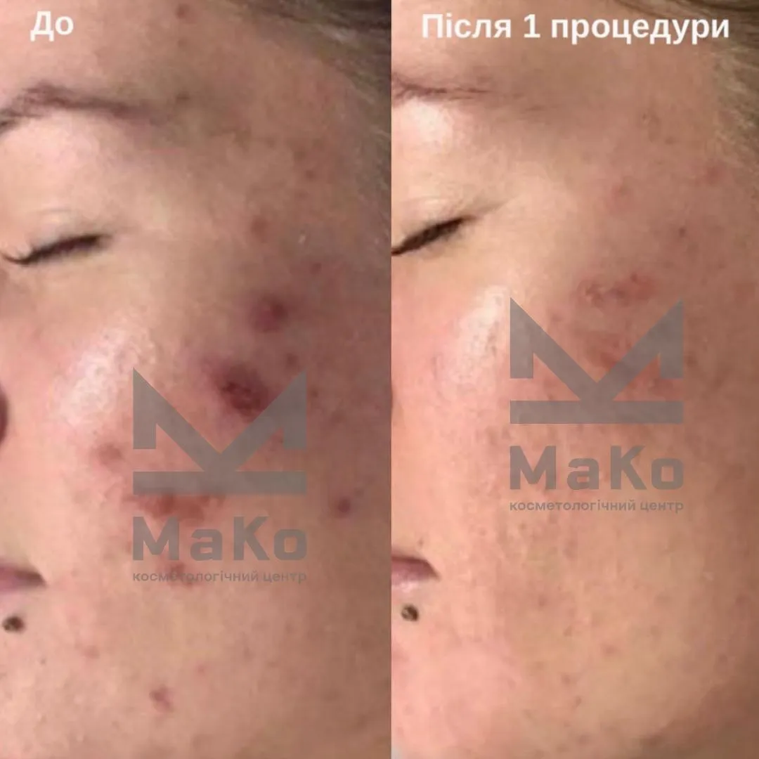 Резурфейсери та пілінги з пептидами