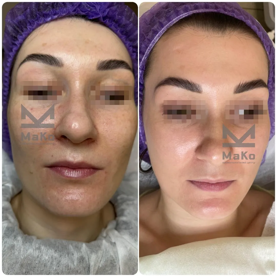 Резурфейсери та пілінги з пептидами