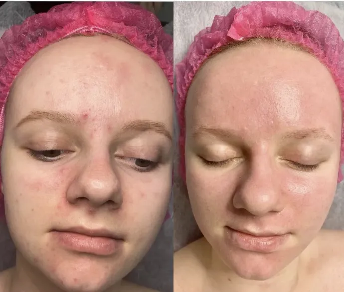 Резурфейсери та пілінги з пептидами