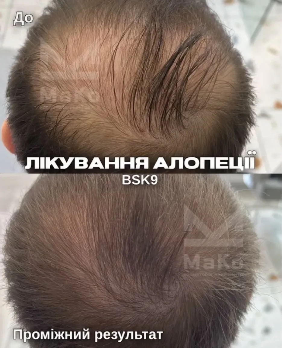 Консультація трихолога