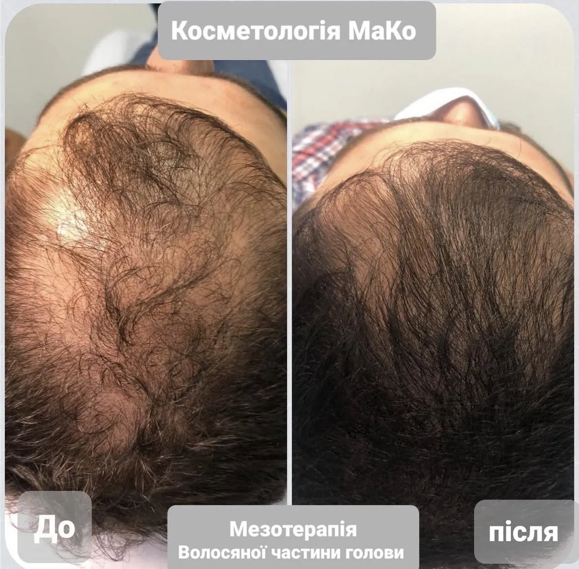 Консультація трихолога