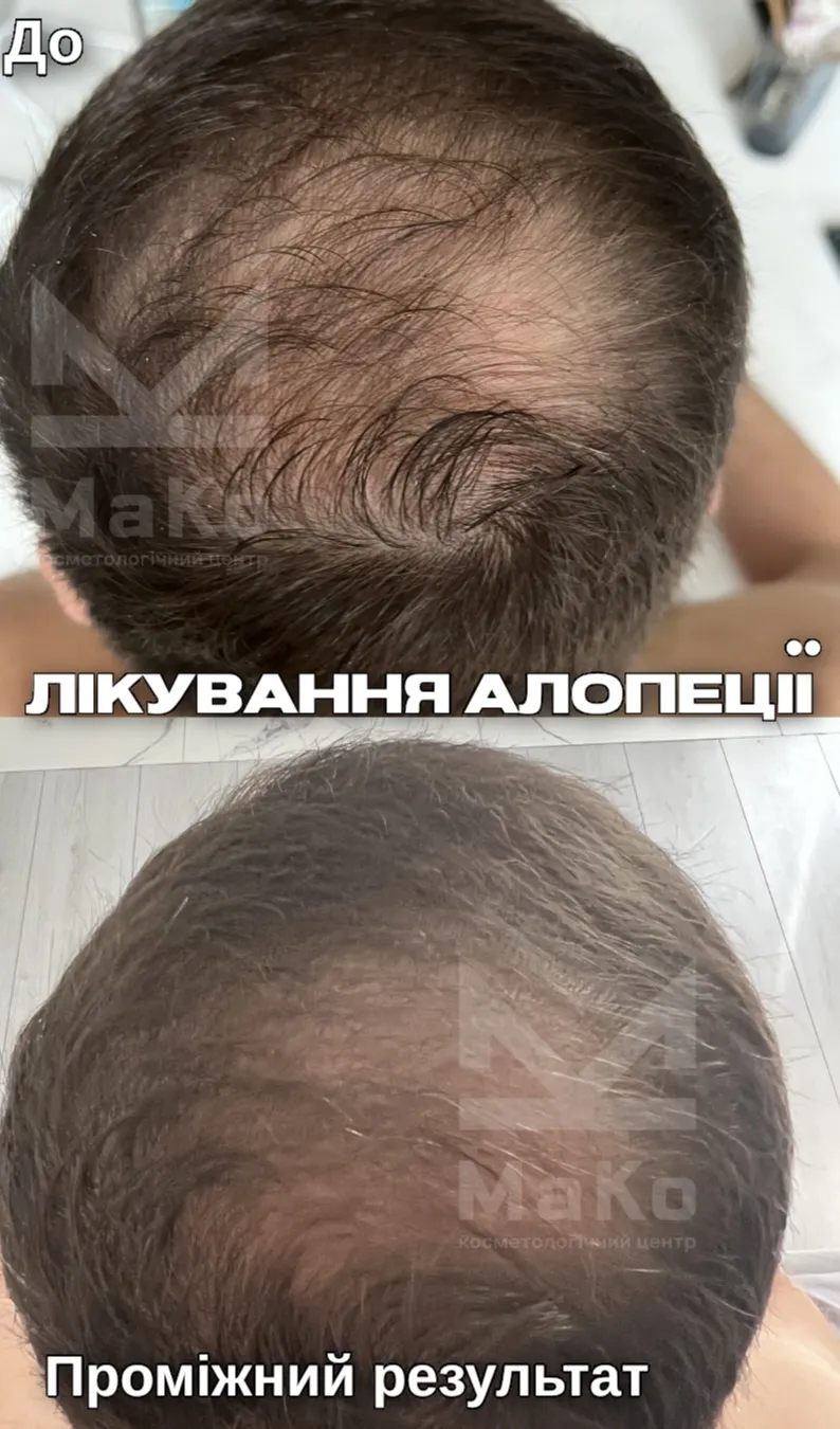 Консультація трихолога