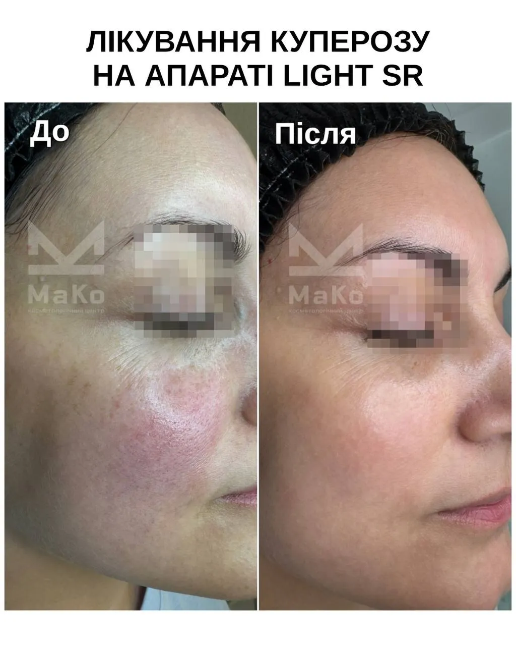 Видалення судин на обличчі, лікування куперозу