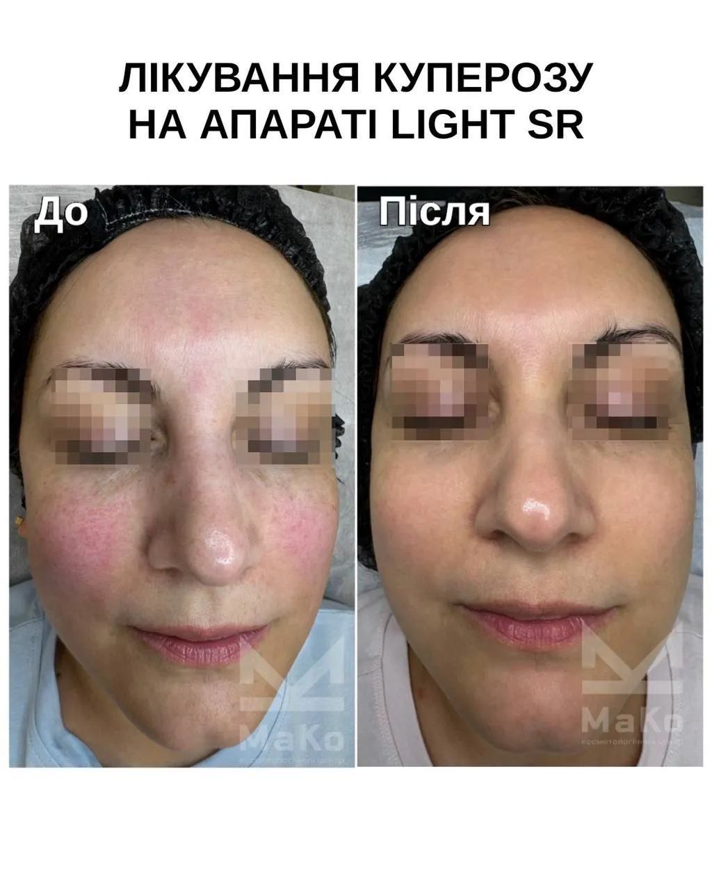 Видалення судин на обличчі, лікування куперозу