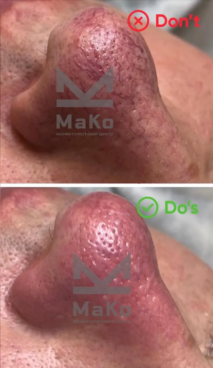 Видалення судин на обличчі, лікування куперозу