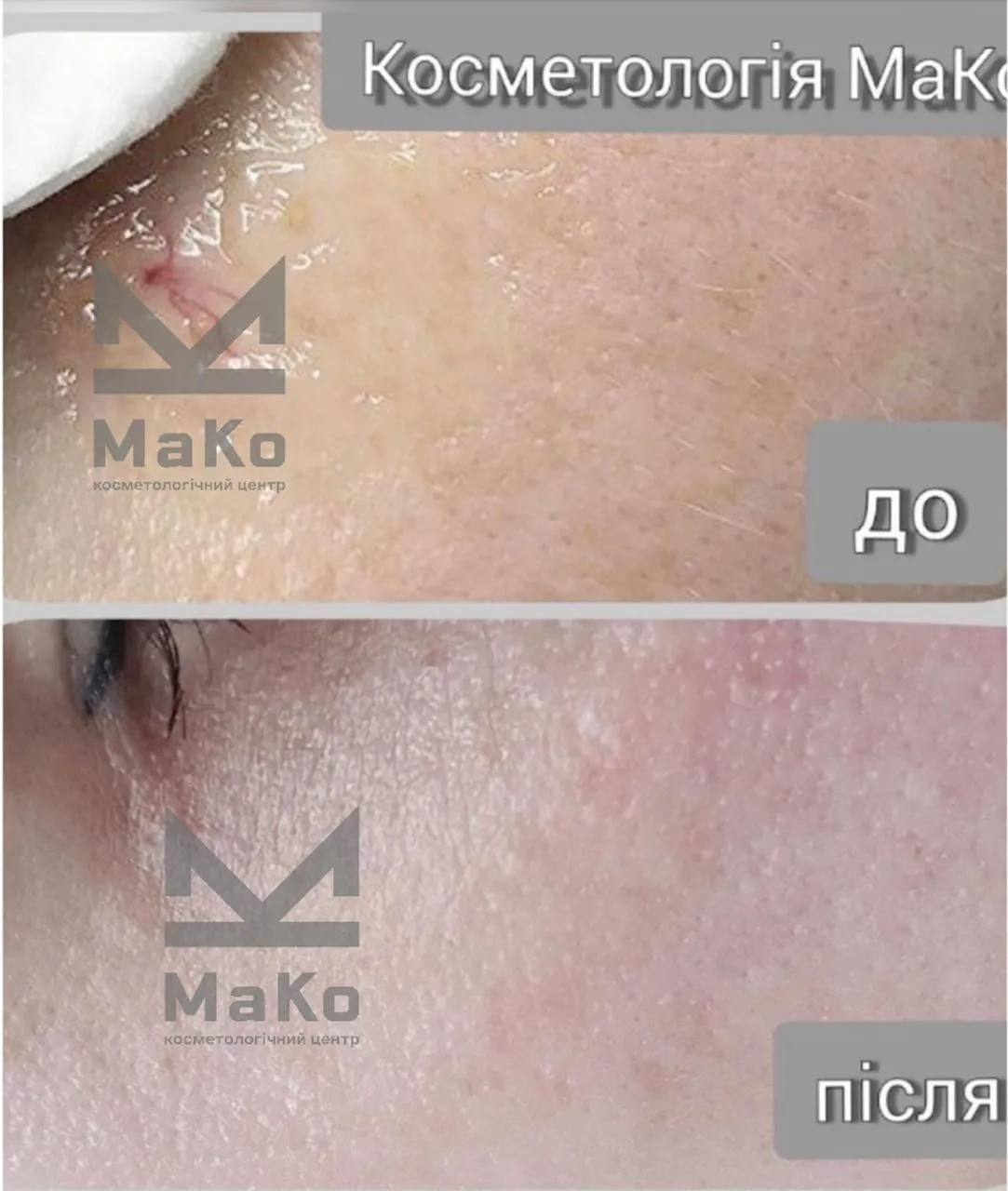 Видалення судин на обличчі, лікування куперозу