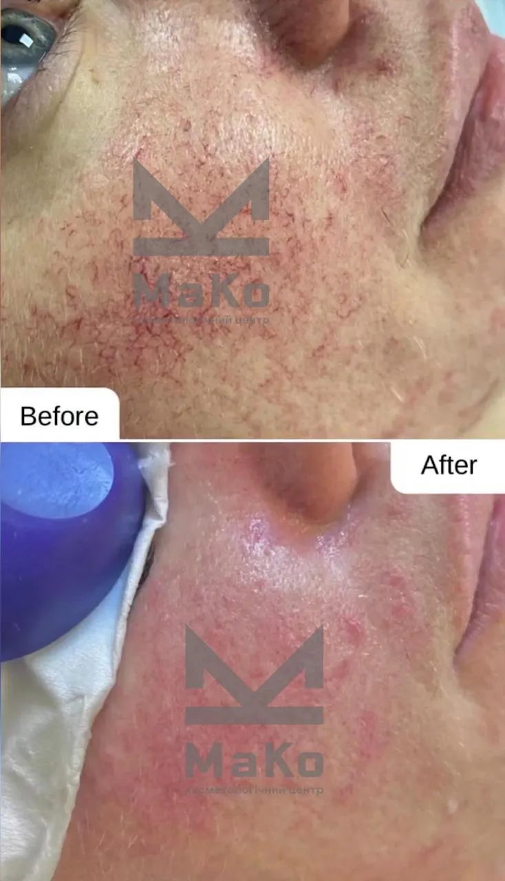 Видалення судин на обличчі, лікування куперозу