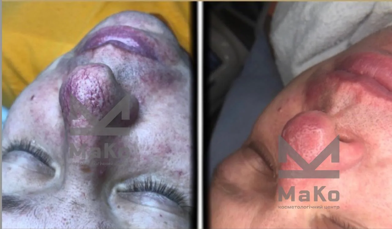 Видалення судин на обличчі, лікування куперозу