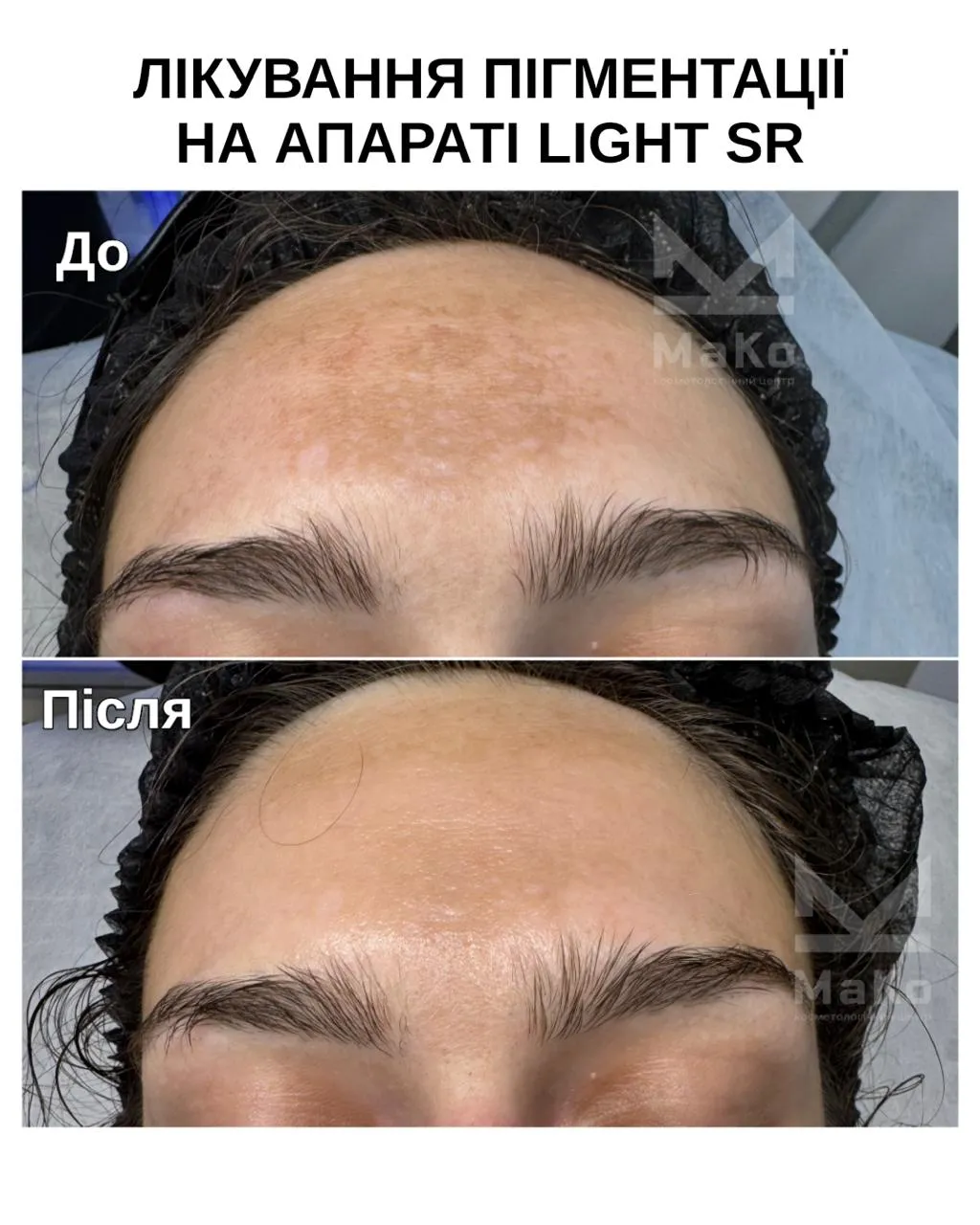 Усунення пігментації