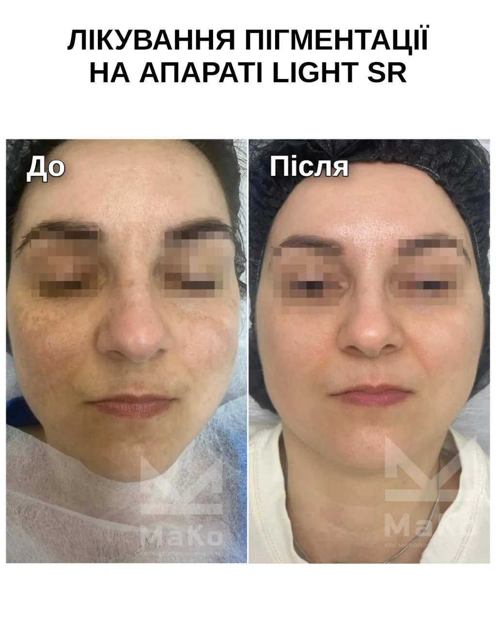 Усунення пігментації