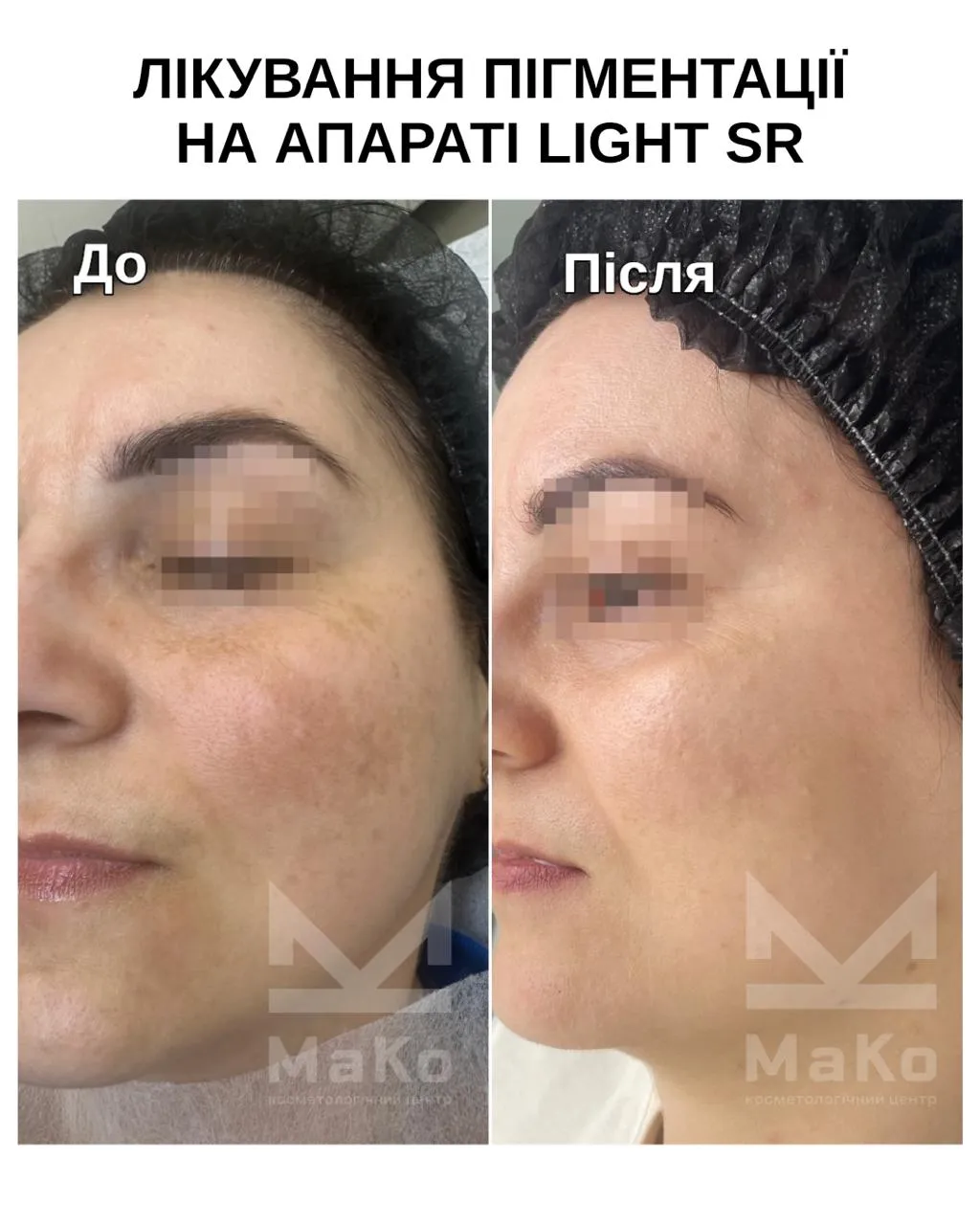 Усунення пігментації