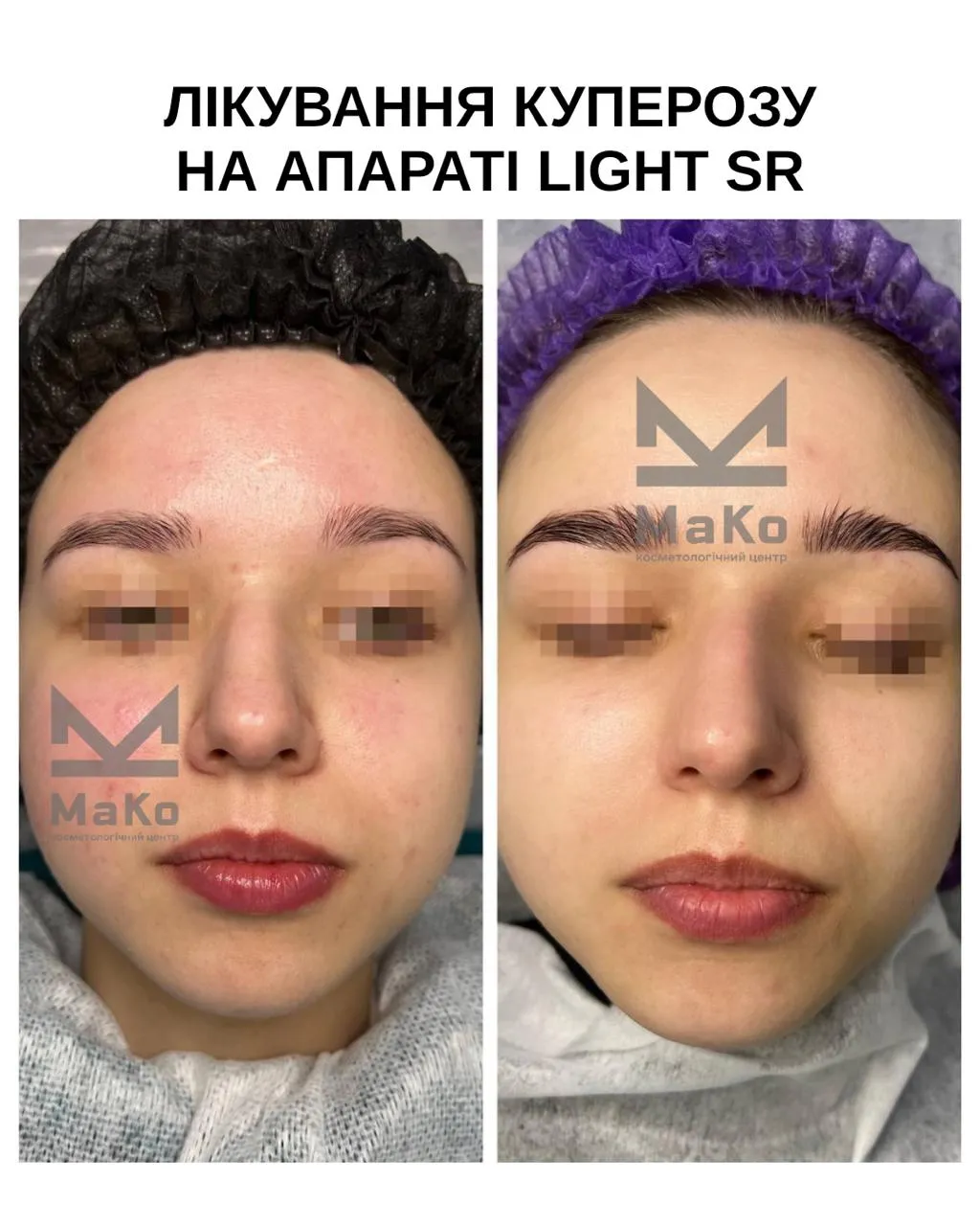 Усунення пігментації