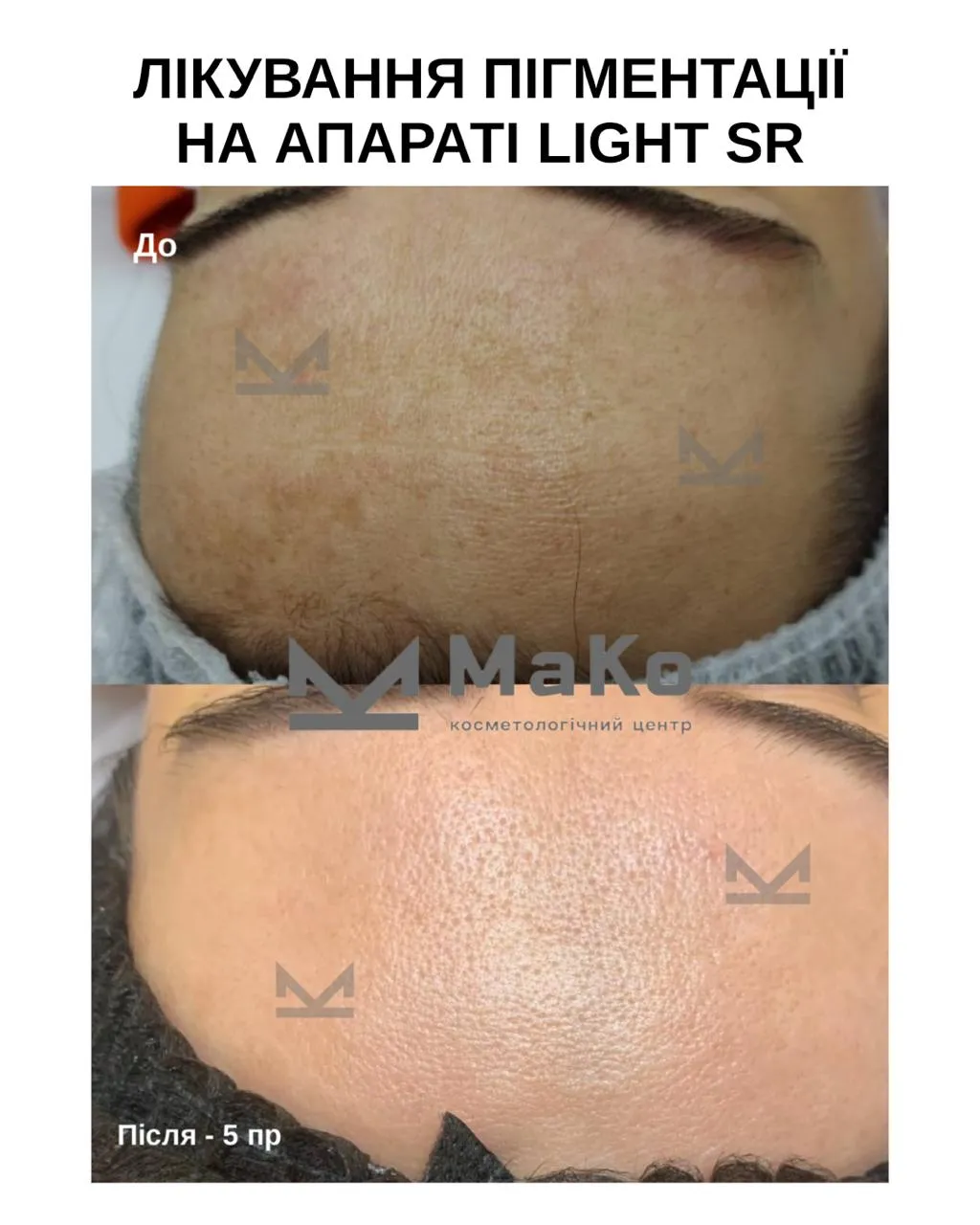 Усунення пігментації