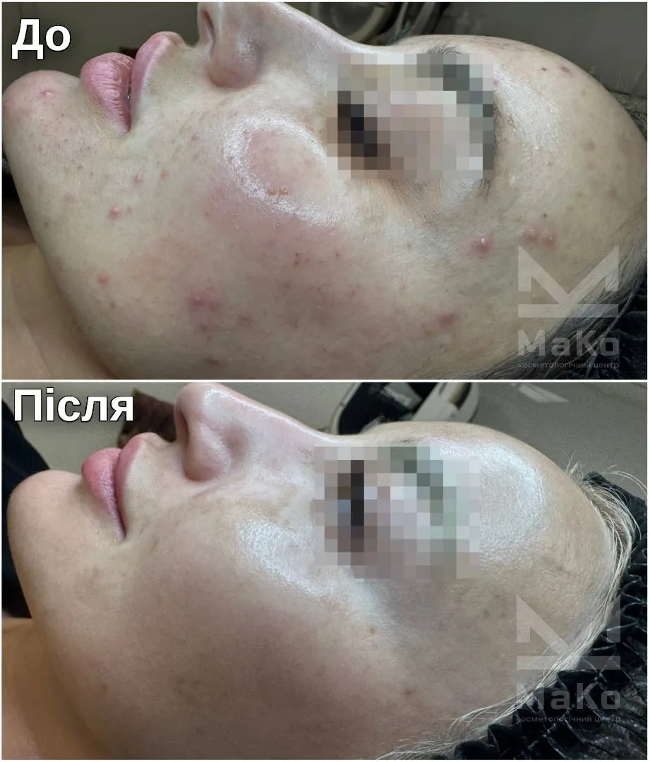 Лікування акне