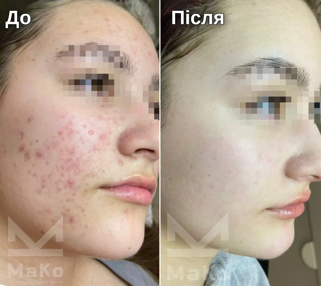 Лікування акне