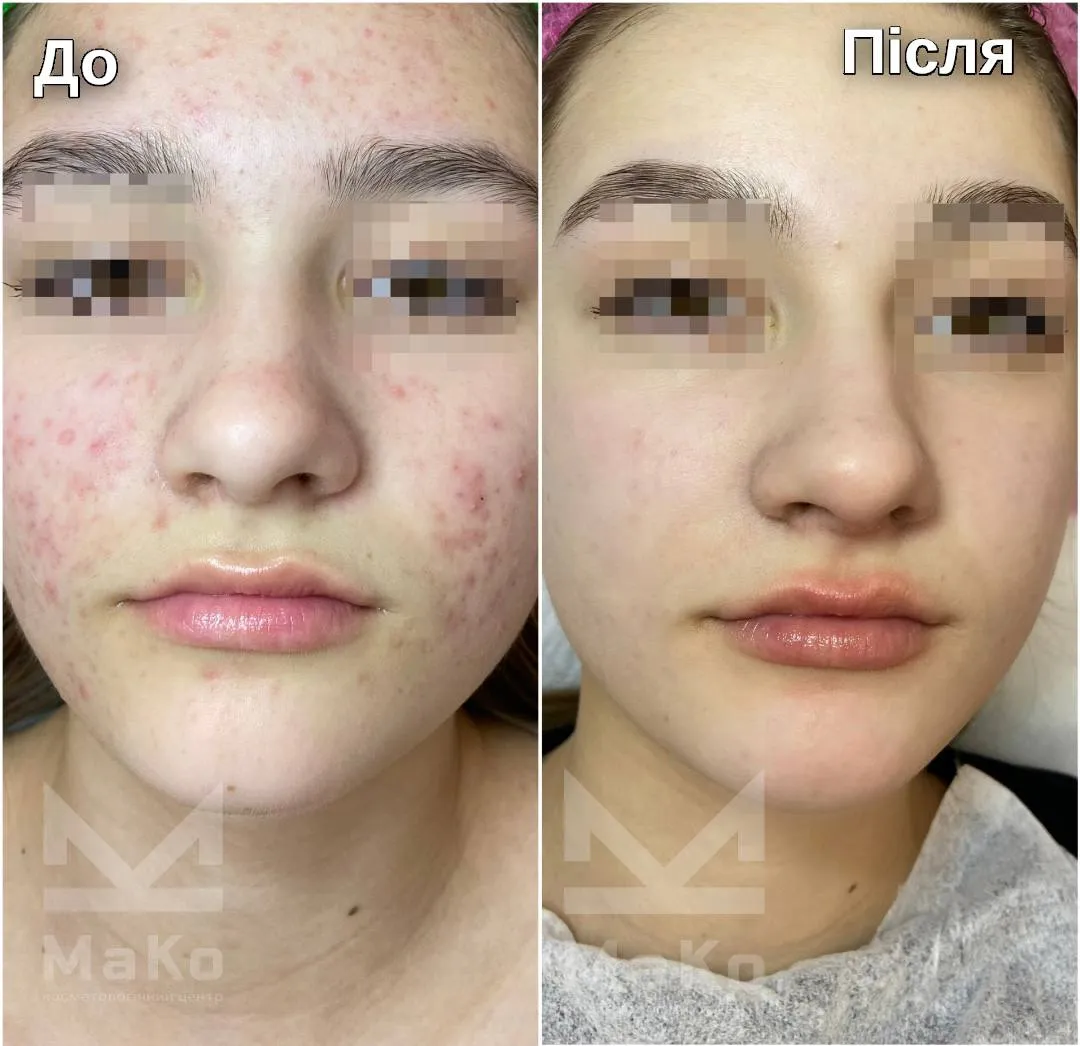 Лікування акне