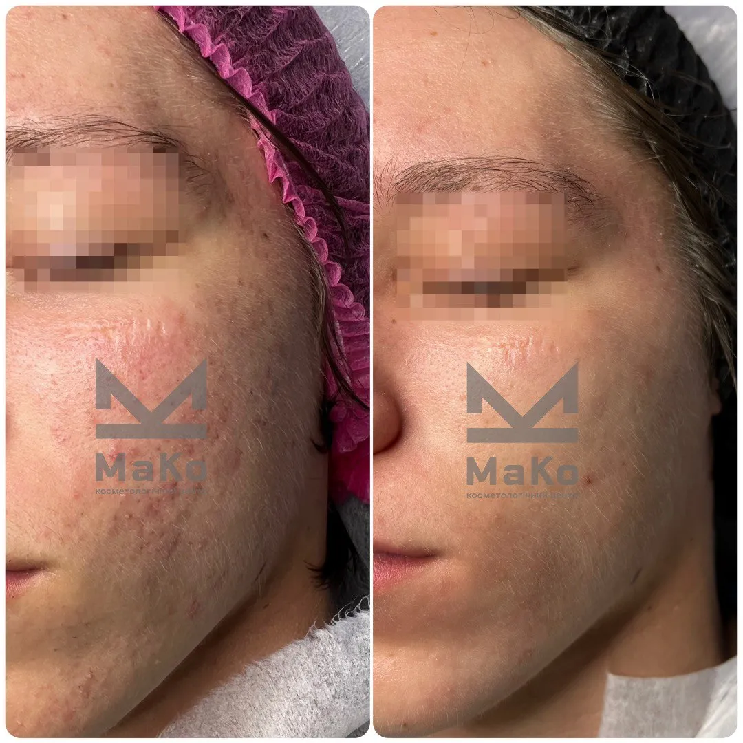 Лікування акне