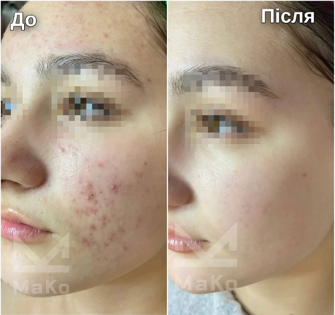Лікування акне