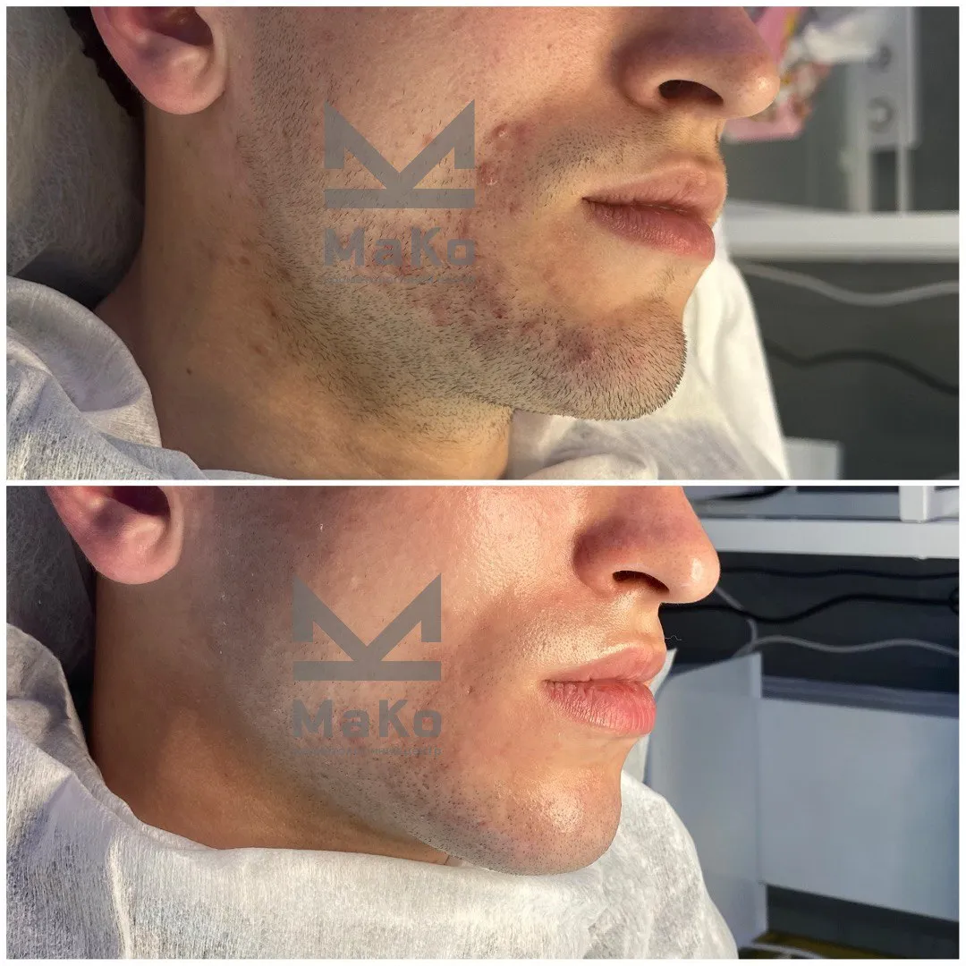 Лікування акне