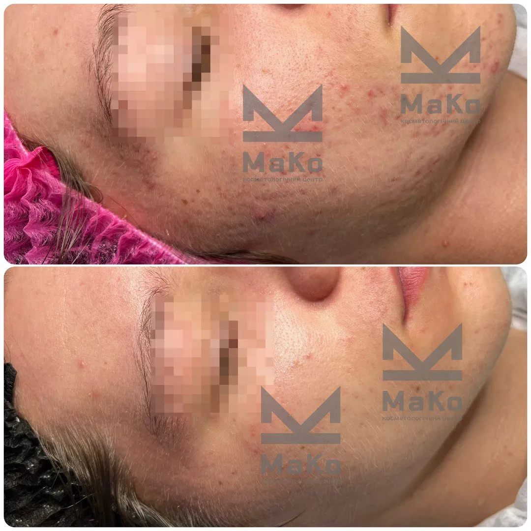 Лікування акне