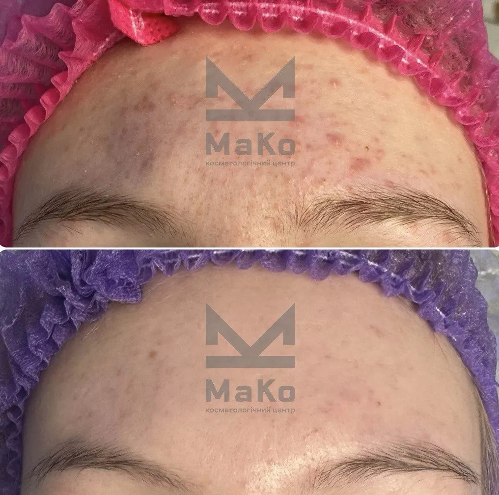 Лікування акне