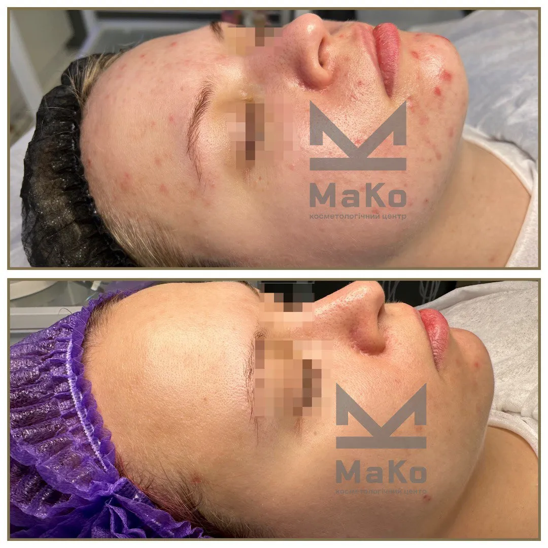 Лікування акне