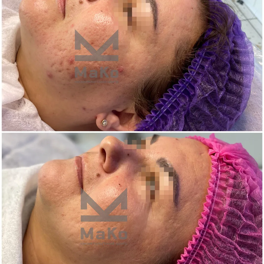 Лікування акне