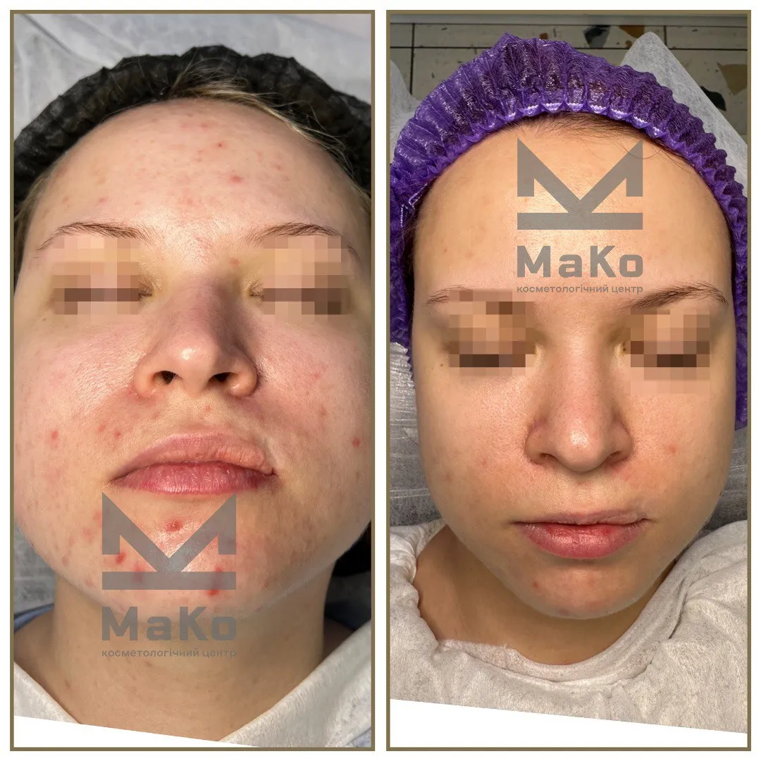 Лікування акне