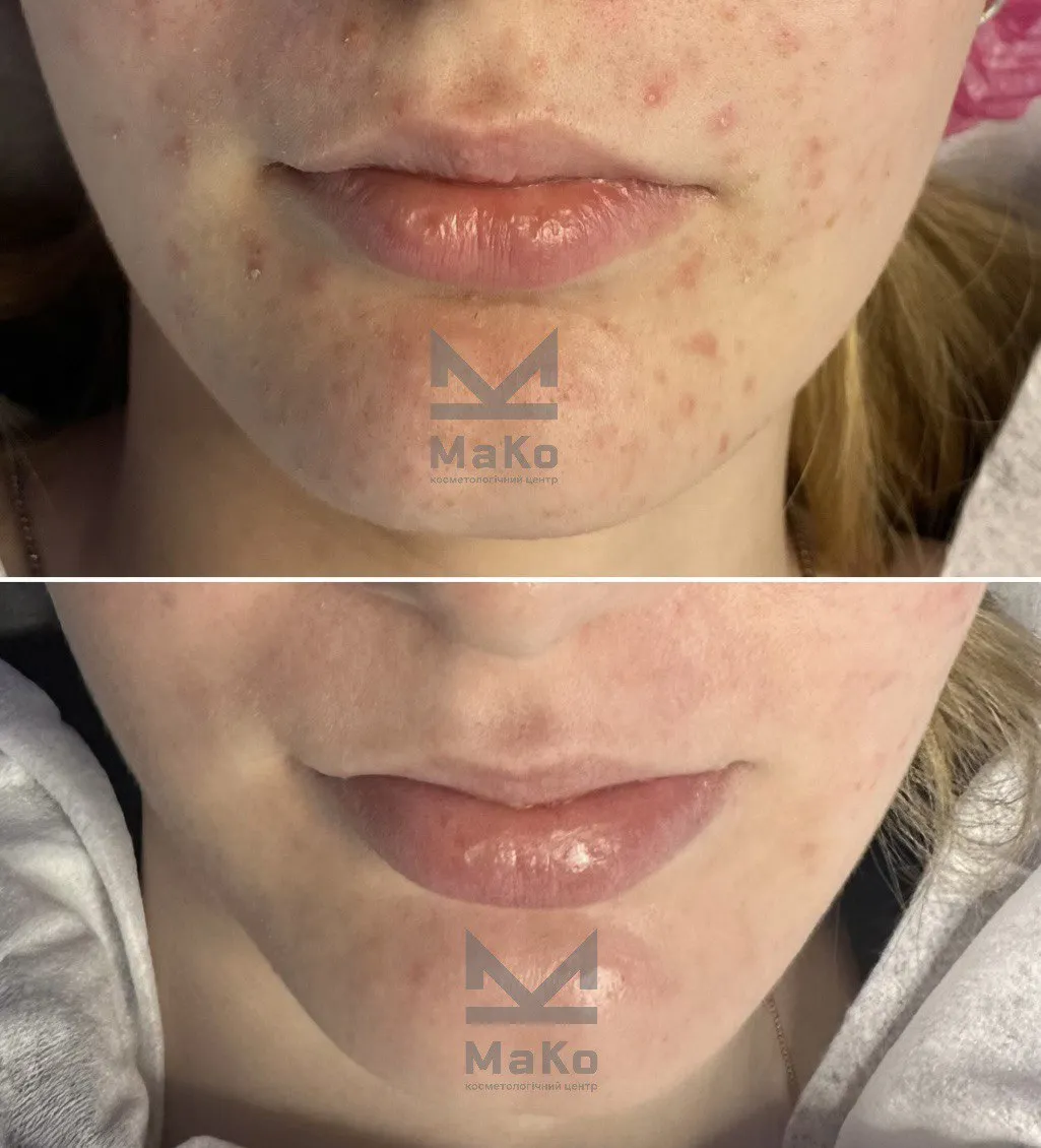 Лікування акне